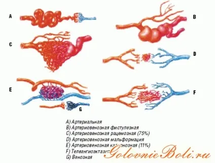 Гемангіома головного мозку у дорослих, лікування кавернозних новоутворень (дорослих) Гемангіома головного мозку у дорослих, лікування кавернозних новоутворень