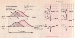 Гіпертрофія правого шлуночка серця що це таке, симптоми, лікування, діагностика, профілактика (гіпертрофія) Гіпертрофія правого шлуночка серця що це таке, симптоми, лікування, діагностика, профілактика