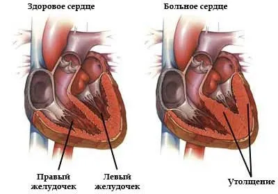 Гіпертрофія правого шлуночка серця ознаки, лікування і діагностика на ЕКГ (ознаки) Гіпертрофія правого шлуночка серця ознаки, лікування і діагностика на ЕКГ