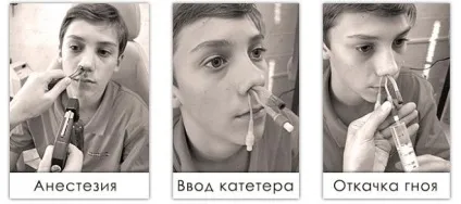 Гнійні виділення з носа лікування і причини гною (носа) Гнійні виділення з носа лікування і причини гною