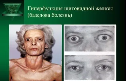Гіперфункція щитовидної залози - що це таке, симптоми підвищення і лікування (залози) Гіперфункція щитовидної залози - що це таке, симптоми підвищення і лікування
