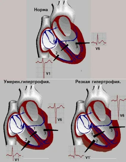 Гіпертрофія правого шлуночка серця ознаки, лікування і діагностика на ЕКГ (гіпертрофія серце шлуночок правий ЕКГ ознаки) Гіпертрофія правого шлуночка серця ознаки, лікування і діагностика на ЕКГ