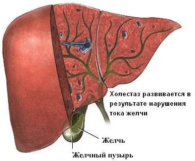Густа жовч причини виникнення порушення і методи лікування (порушення) Густа жовч причини виникнення порушення і методи лікування