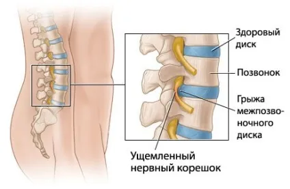Грижа міжхребцевого диска хребта симптоми, ознаки, причини виникнення, клінічні (грижа) Грижа міжхребцевого диска хребта симптоми, ознаки, причини виникнення, клінічні