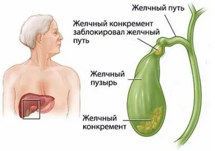 Густа жовч причини виникнення порушення і методи лікування (5657011329 густа жовч) Густа жовч причини виникнення порушення і методи лікування