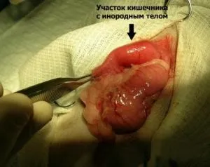 Чужорідне тіло в жкт