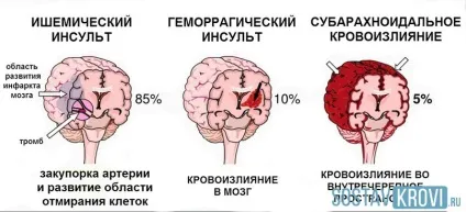 Інсульт стовбура головного мозку ішемічний, геморагічний, чи можливо одужання, самий (геморагічний) Інсульт стовбура головного мозку ішемічний, геморагічний, чи можливо одужання, самий