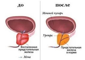 З чого складається комплексний курс лікування хронічного простатиту (хронічного) З чого складається комплексний курс лікування хронічного простатиту