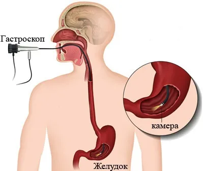 Як часто можна робити гастроскопію і з якими цілями (часто) Як часто можна робити гастроскопію і з якими цілями
