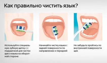 Як чистити мову зубною щіткою і прибрати з нього наліт (щіткою) Як чистити мову зубною щіткою і прибрати з нього наліт