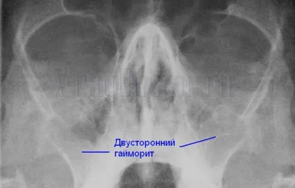 Як Новомосковскть рентгенівські знімки легень, хребта, пазух носа (легких) Як Новомосковскть рентгенівські знімки легень, хребта, пазух носа