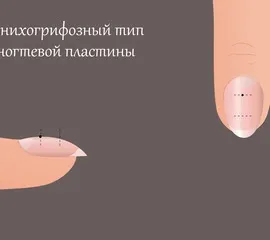 Які помилки існують в моделюванні нігтів (помилки) Які помилки існують в моделюванні нігтів