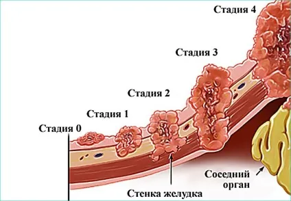 Які можуть бути ускладнення у гастриту (ускладнення гастрит хронічний гострий реабілітація) Які можуть бути ускладнення у гастриту