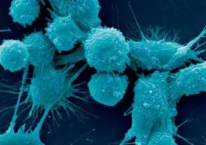 Як лікувати рак матки променева терапія, дієта, операційне видалення, хіміотерапія, профілактика (видалення матки при раку матки) Як лікувати рак матки променева терапія, дієта, операційне видалення, хіміотерапія, профілактика