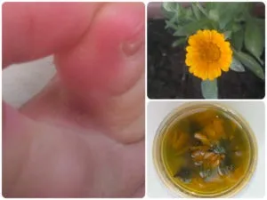 Як лікувати грибок на ногах в домашніх умовах за допомогою аптечних і народних засобів, грибкові (лікування грибка на ногах в домашніх умовах) Як лікувати грибок на ногах в домашніх умовах за допомогою аптечних і народних засобів, грибкові