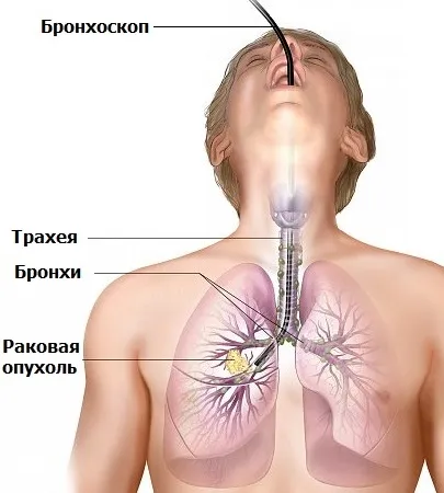 Як визначити рак легенів (рентгенографія органів грудної) Як визначити рак легенів