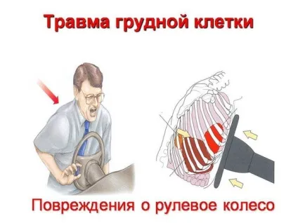 Як визначити забій або перелому ребер (перелому) Як визначити забій або перелому ребер