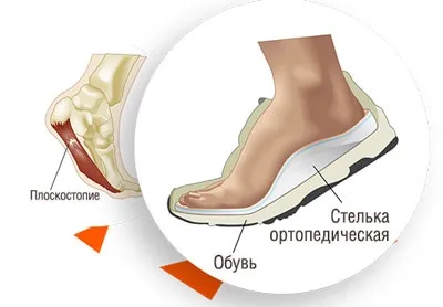 Як підібрати ортопедичні устілки для дорослих і що вони лікують (ортопедичні) Як підібрати ортопедичні устілки для дорослих і що вони лікують