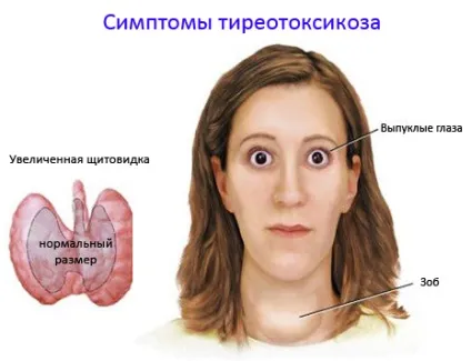 Як проявляється щитовидка ознаки і симптоми з різновидами (патології щитовидної залози) Як проявляється щитовидка ознаки і симптоми з різновидами
