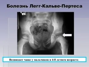 Остеохондропатия лікування некрозу кісткової тканини різних суглобів (остеохондропатия горбистості великогомілкової кістки) Остеохондропатия лікування некрозу кісткової тканини різних суглобів
