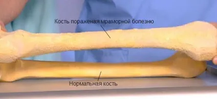 Остеосклероз - класифікація, симптоми і лікування (Крім того захворювання) Остеосклероз - класифікація, симптоми і лікування