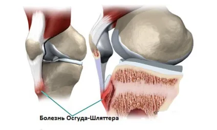 Остеохондропатия горбистості великогомілкової кістки (бугристости) Остеохондропатия горбистості великогомілкової кістки