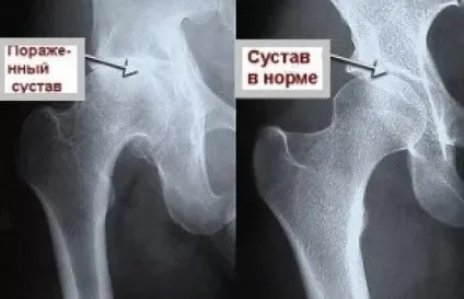 Гострий моноартрит 1
