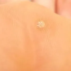 Шіпіци на ногах (ступнях, пальцях і п'ятах) (ввечері залишаючи пов'язку) Шіпіци на ногах (ступнях, пальцях і п'ятах)