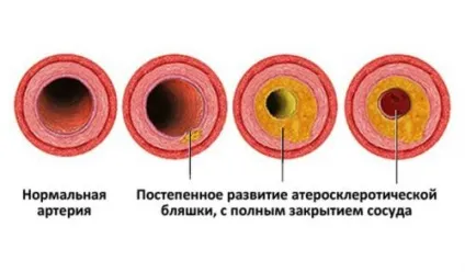 Як знизити ниркове тиск в домашніх умовах (знизити його будинку) (знизити) Як знизити ниркове тиск в домашніх умовах (знизити його будинку)