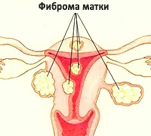Як вилікувати фіброму матки без операції (Вилікувати фиброму матки) Як вилікувати фіброму матки без операції