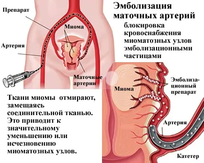 Як вилікувати фіброму матки без операції (фіброму) Як вилікувати фіброму матки без операції