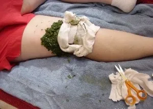 Капустяний лист при артрозі колінного суглоба показання до застосування, відгуки (артрозі) Капустяний лист при артрозі колінного суглоба показання до застосування, відгуки