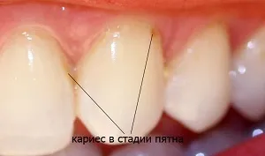 Карієс що це таке, стадії захворювання і його симптоми (розвиток карієсу) Карієс що це таке, стадії захворювання і його симптоми