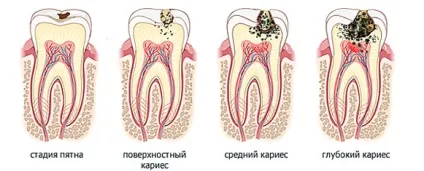 Карієс що це таке, стадії захворювання і його симптоми (стадії карієсу) Карієс що це таке, стадії захворювання і його симптоми