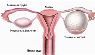 Кіста яєчників ознаки, розміри, види, симптоми і лікування кісти яєчників у жінок (кіста) Кіста яєчників ознаки, розміри, види, симптоми і лікування кісти яєчників у жінок
