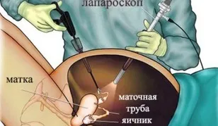 Кіста яєчників ознаки, розміри, види, симптоми і лікування кісти яєчників у жінок (яєчників) Кіста яєчників ознаки, розміри, види, симптоми і лікування кісти яєчників у жінок