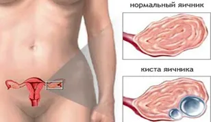 Кіста яєчників ознаки, розміри, види, симптоми і лікування кісти яєчників у жінок (кіста) Кіста яєчників ознаки, розміри, види, симптоми і лікування кісти яєчників у жінок