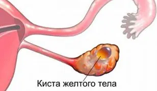 Кіста яєчників ознаки, розміри, види, симптоми і лікування кісти яєчників у жінок (види) Кіста яєчників ознаки, розміри, види, симптоми і лікування кісти яєчників у жінок