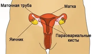 Кіста яєчників ознаки, розміри, види, симптоми і лікування кісти яєчників у жінок (ознаки) Кіста яєчників ознаки, розміри, види, симптоми і лікування кісти яєчників у жінок