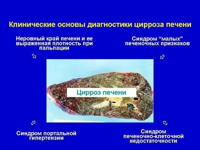 Клініка, діагностика, лікування цирозів печінки (медичні конференції) Клініка, діагностика, лікування цирозів печінки
