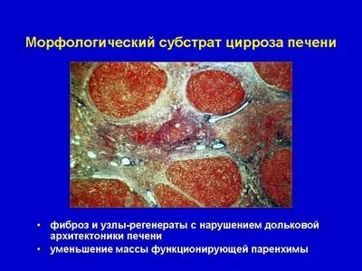Клініка, діагностика, лікування цирозів печінки (терапія) Клініка, діагностика, лікування цирозів печінки