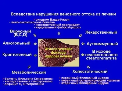 Клініка, діагностика, лікування цирозів печінки (кардіального відділу шлунку) Клініка, діагностика, лікування цирозів печінки