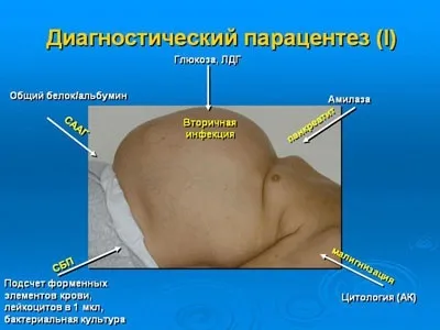 Клініка, діагностика, лікування цирозів печінки (печінки) Клініка, діагностика, лікування цирозів печінки