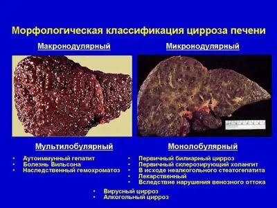 Клініка, діагностика, лікування цирозів печінки (діагностика) Клініка, діагностика, лікування цирозів печінки
