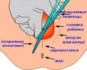 Шви на промежині після пологів догляд, обробка, насторожують симптоми (пологів) Шви на промежині після пологів догляд, обробка, симптоми, що насторожують