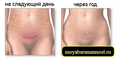 Шрам після кесаревого розтину, моя вагітність (перетину) Шрам після кесаревого розтину, моя вагітність