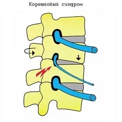 Корінцевий синдром поперекового відділу 5 симптомів і їх лікування (поперекового) Корінцевий синдром поперекового відділу 5 симптомів і їх лікування