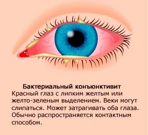 Кон'юнктивіт у дітей лікування (Бактеріальний кон'юнктивіт Лікування) Кон'юнктивіт у дітей лікування