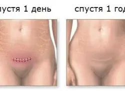 Лапаротомія по Пфанненштилю (лапаротомія) Лапаротомія по Пфанненштилю