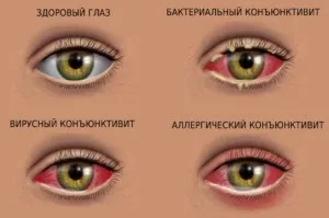 Лікування дитячого кон'юнктивіту очей по Комаровському (очей) Лікування дитячого кон'юнктивіту очей по Комаровському